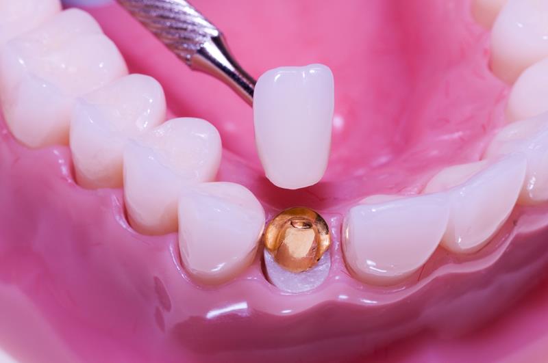 Porcelain Dental Crowns