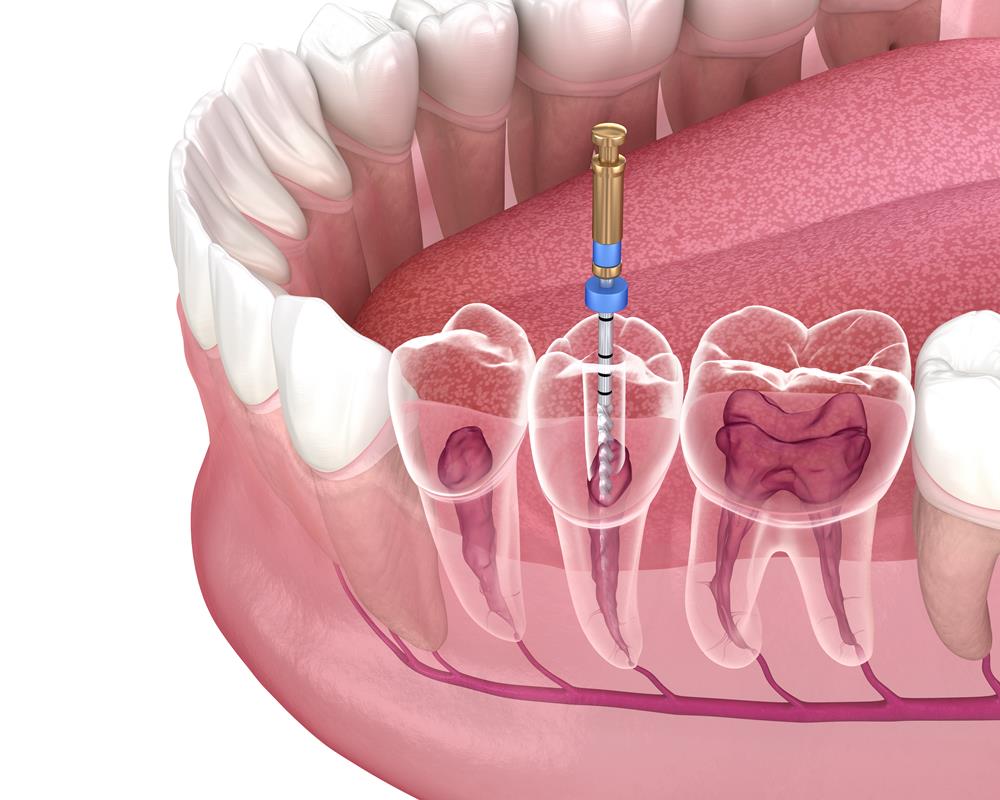 Root canal treatment procedure
